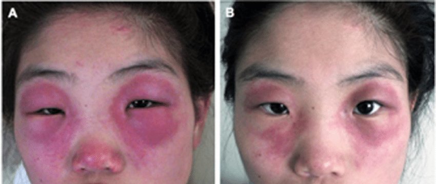 Haliotrop Rash PHY6405 Visceral Pathology Laboratory